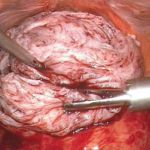 怀孕合并子宫肌瘤-北京安太医院去瘤保胎，3D腹腔镜显神通