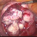 生命不能承受子宫肌瘤之重