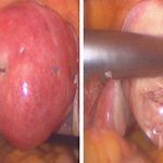 子宫肌瘤-能生和不想生不是一回事