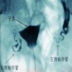 不孕检查之子宫输卵管碘油造影