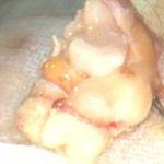 侏儒症女体内惊现“老人头”{畸胎瘤}