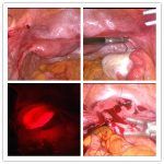 输卵管不通北京安太医院嫁接后结出幸福之果