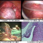 导致不孕的卵巢巧克力囊肿在北京安太医院成功剔除