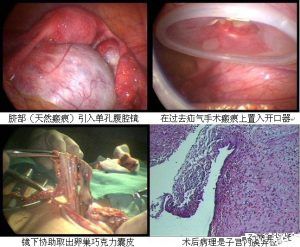 导致不孕的卵巢巧克力囊肿在北京安太医院成功剔除