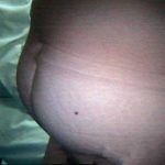 子宫肌瘤症状之腹部及压迫症状