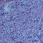 子宫肌瘤之再重逢沧海桑田 家人别为我泪流