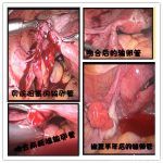 输卵管不通只有试管这一条路?