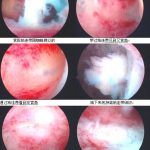 子宫腔显蜘蛛网-肌瘤术后继发宫腔粘连