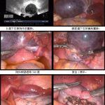怀孕合并卵巢蒂扭转在北京安太医院救治