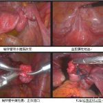 输卵管不通做了两次试管都失败