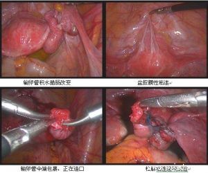 输卵管不通做了两次试管都失败