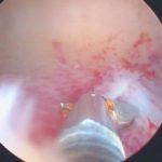 取掉了子宫内膜息肉还是不孕究竟为何?