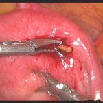 放环后腹痛不消原来是环穿孔!