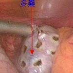 大嫂子多囊不孕，是我拯救了她