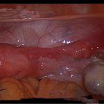 生殖道畸形的症状