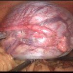 体检发现卵巢囊肿一定要及时治