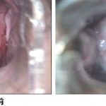 重度宫颈糜烂CIN一定要及时治疗