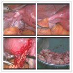 治了多年的不孕，原来输卵管早被切