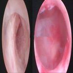 重度宫腔粘连在北京安太医院得到救治