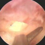 宫腔粘连检查之宫腔镜