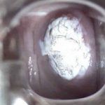 16 型hpv病毒检测阳性，怎么治疗呢?