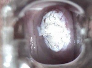 16 型hpv病毒检测阳性，怎么治疗呢?