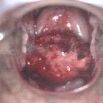 宫颈糜烂碘试验及活检