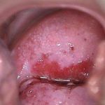 宫颈癌III期错失了手术的机会