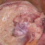 腺肌症将她推向了自杀的路