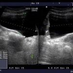 尿失禁的她终于敢出远门了