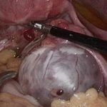 子宫内膜异位之卵巢巧克力囊肿治疗方法