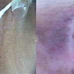 外阴白斑导致的外阴萎缩求助于北京安太医院