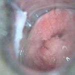 同房出血要警惕宫颈糜烂