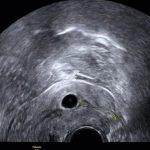 宫颈异位妊娠在北京安太医院救治成功