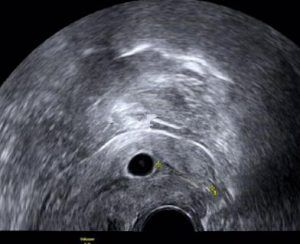 宫颈妊娠图片