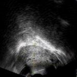 闭经是因为子宫内膜增生紊乱