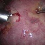 子宫腺肌症拒绝切子宫 做不完整的女人