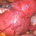 可怕的子宫内膜异位之痛经十年，每次都在加重