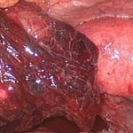 子宫内膜异位病因之种植学说