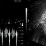 北京安太医院救助6次宫外孕的她