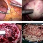 腺肌症拖久了要切子宫