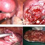 子宫腺肌症-痛经导致的离婚案