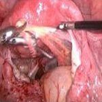 北京安太医院救治痛经22年的子宫内膜异位患者