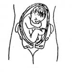 我的宝宝是臀位，在北京安太医院照样水中顺产哦！