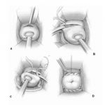 流产我之见之双安太环
