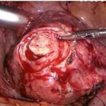 她患子宫肌瘤 不远万里求医于北京安太医院