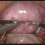 腺肌症痛经得吃20片止痛片