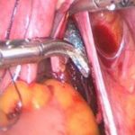 产后便秘新疗法