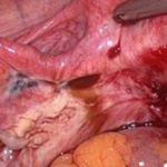 子宫内膜异位3d腹腔镜探查