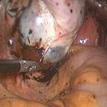 月经紊乱3年不孕只因内膜异位症